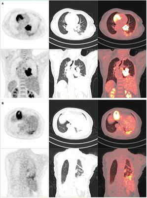 Situs Inversus Totalis on 18F-FDG PET/CT: A Case Report and a Literature Review